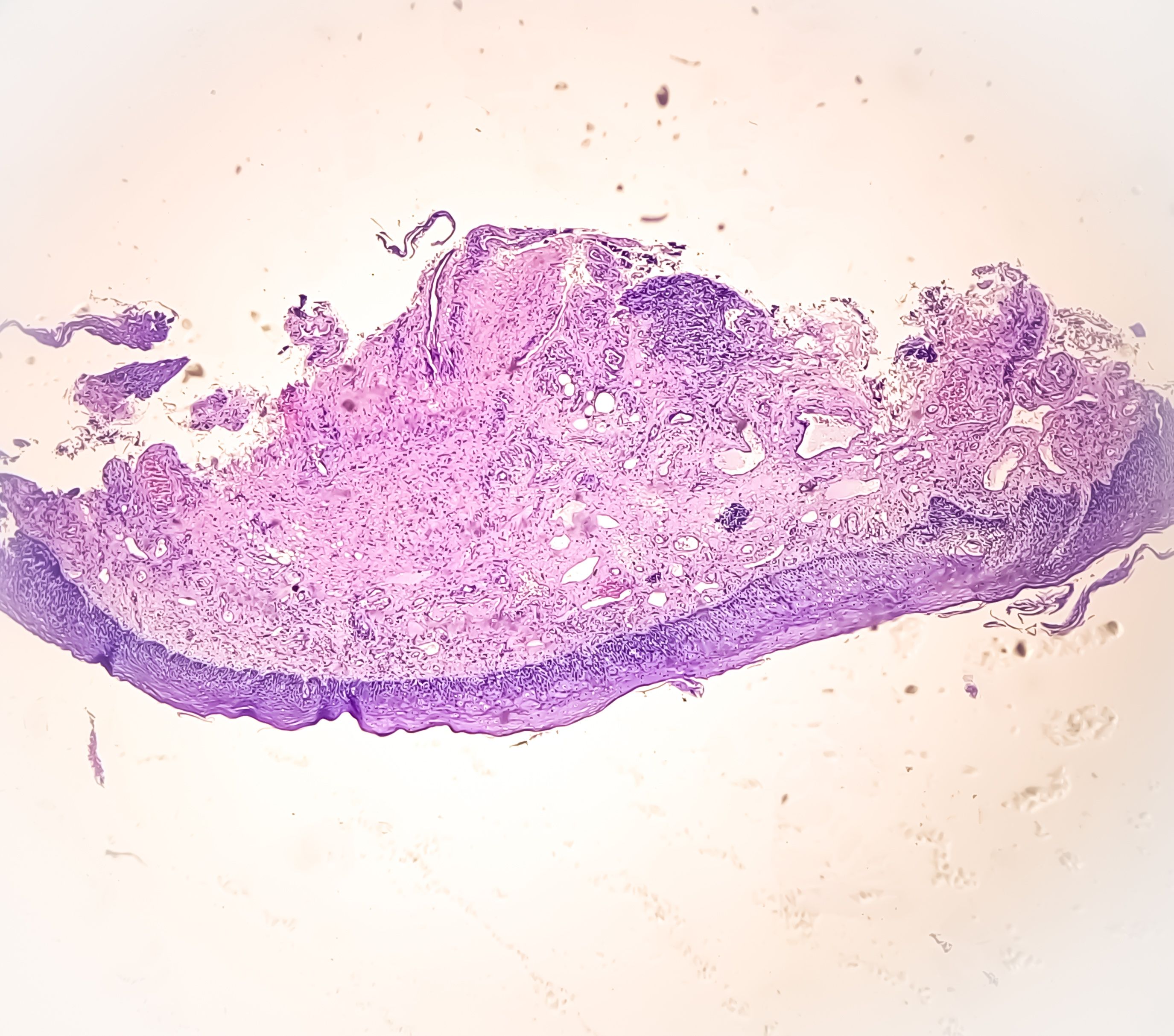 ASCO 2025: Novel Bispecific T-Cell Engager Targeting DLL3 Offers Hope for Refractory Neuroendocrine Carcinomas
