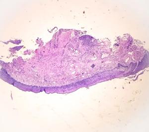 ASCO 2025: Novel Bispecific T-Cell Engager Targeting DLL3 Offers Hope for Refractory Neuroendocrine Carcinomas