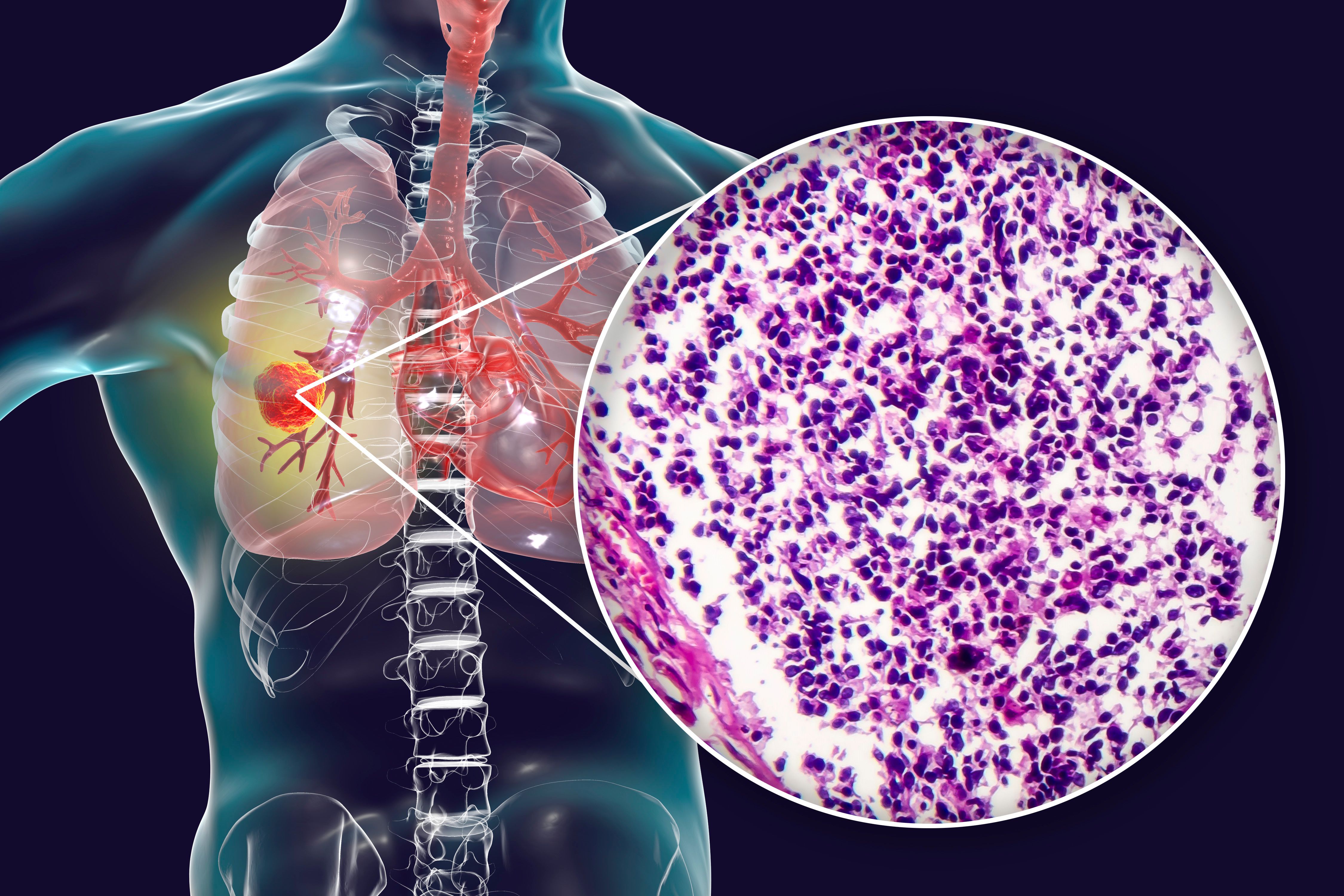 X-ray scan of NSCLC -- Image credit: Dr_Microbe | stock.adobe.com