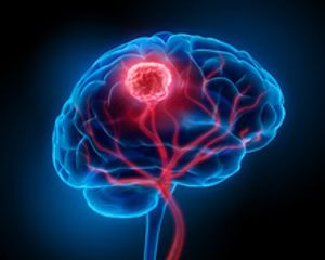 Advances in Glioblastoma Multiforme Shift the Treatment Paradigm 