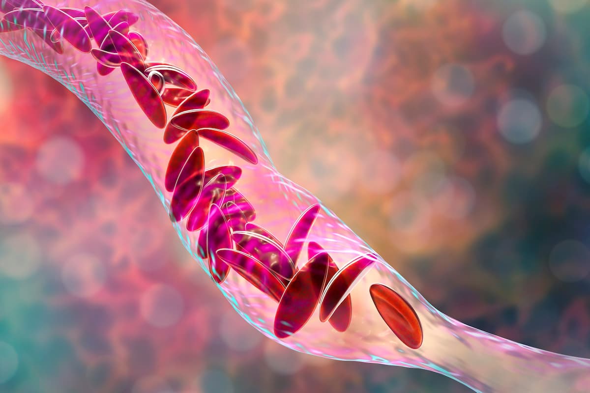 Sickle cell anemia, 3D illustration. Clumps of sickle cell block the blood vessel