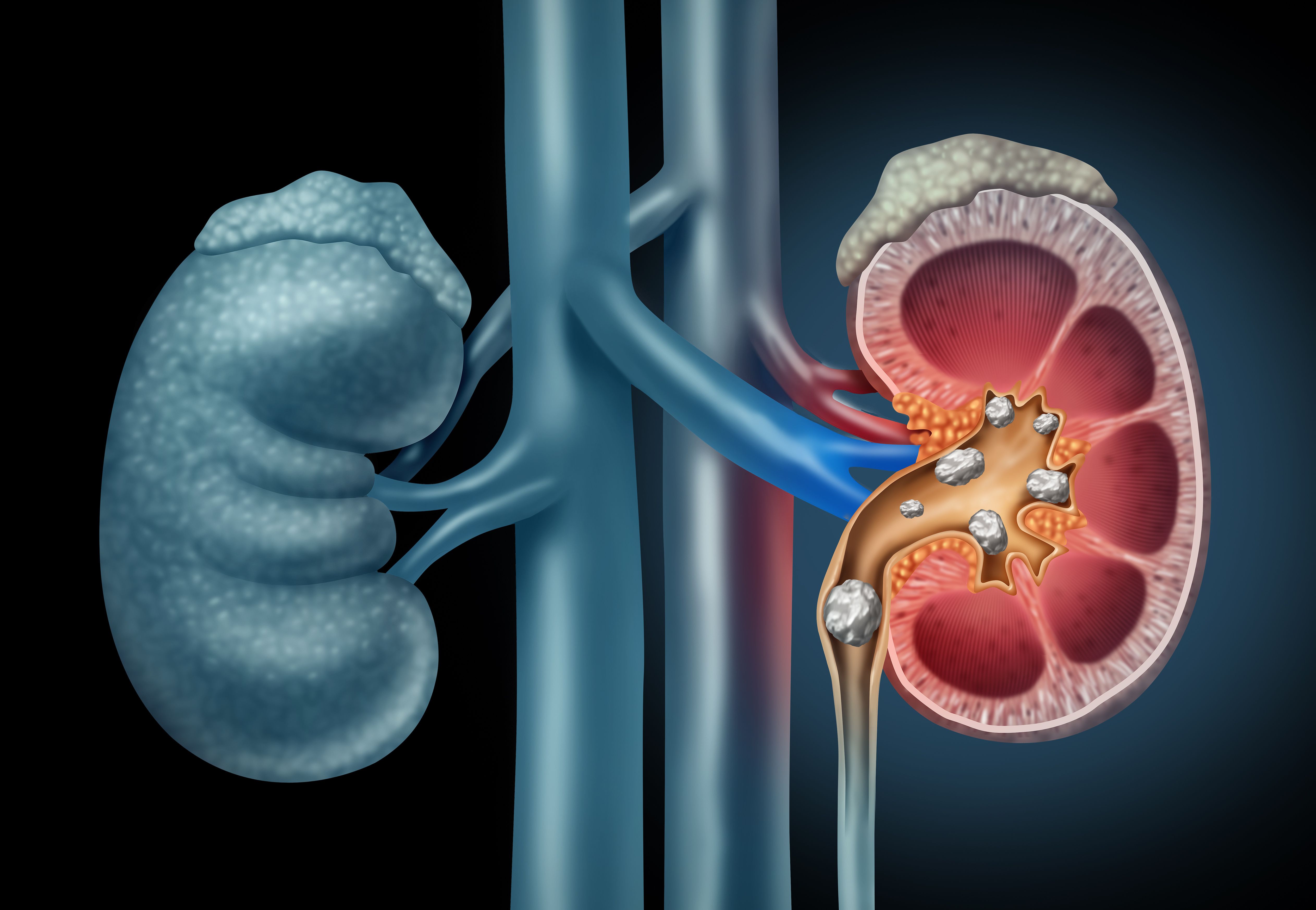 Human kidney Stones Medical Concept - Image credit: freshidea | stock.adobe.com