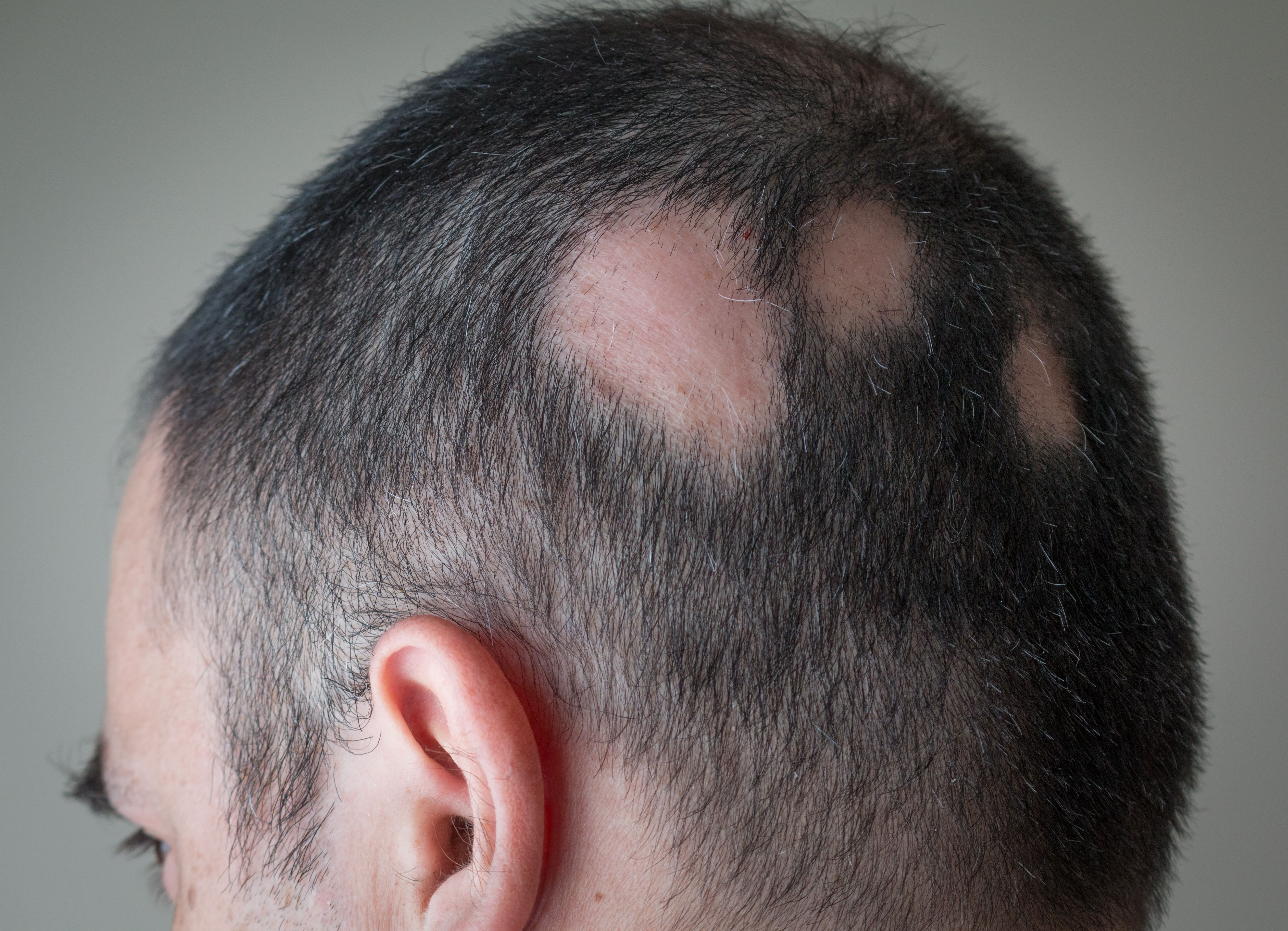 Alopecia Aerata - Spot Baldness - Image credit: Alex Papp | stock.adobe.com