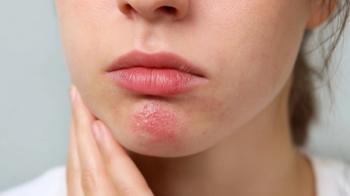 FDA Approves Pritelivir for Refractory HSV Lesions in Immunocompromised Adults
