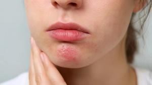 FDA Approves Pritelivir for Refractory HSV Lesions in Immunocompromised Adults