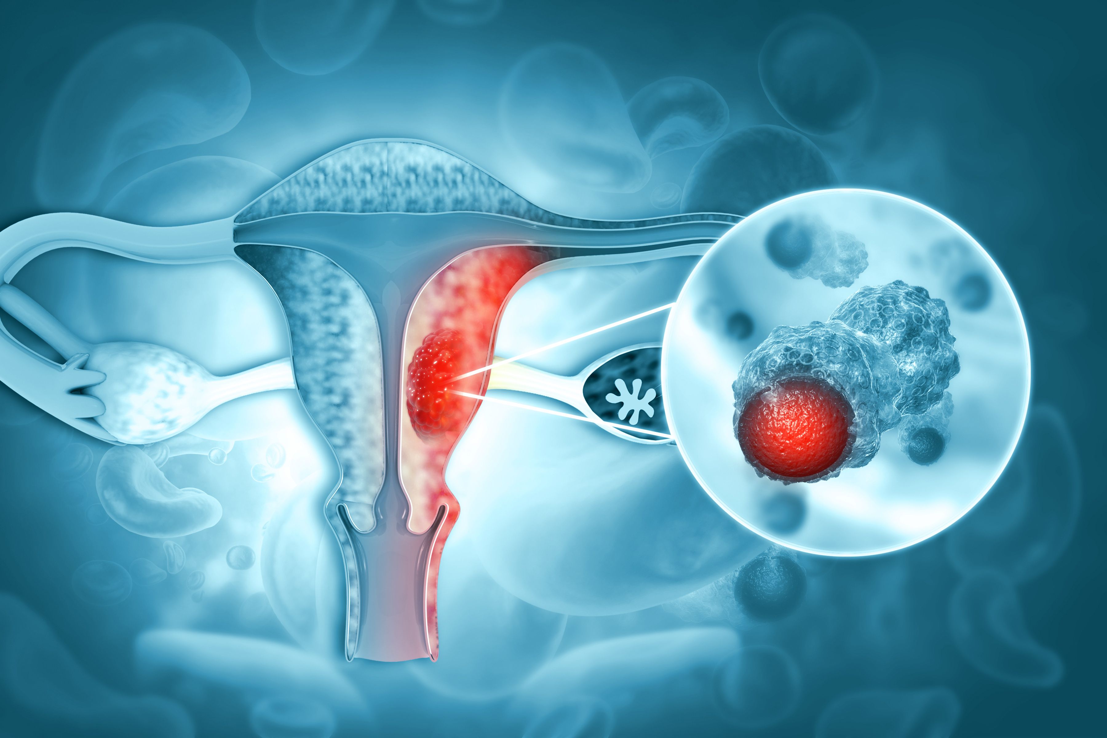 Female reproductive system diseases.uterus cancer and endometrial malignant tumor as a uterine medical concept.3d illustration - Image credit: Crystal light | stock.adobe.com
