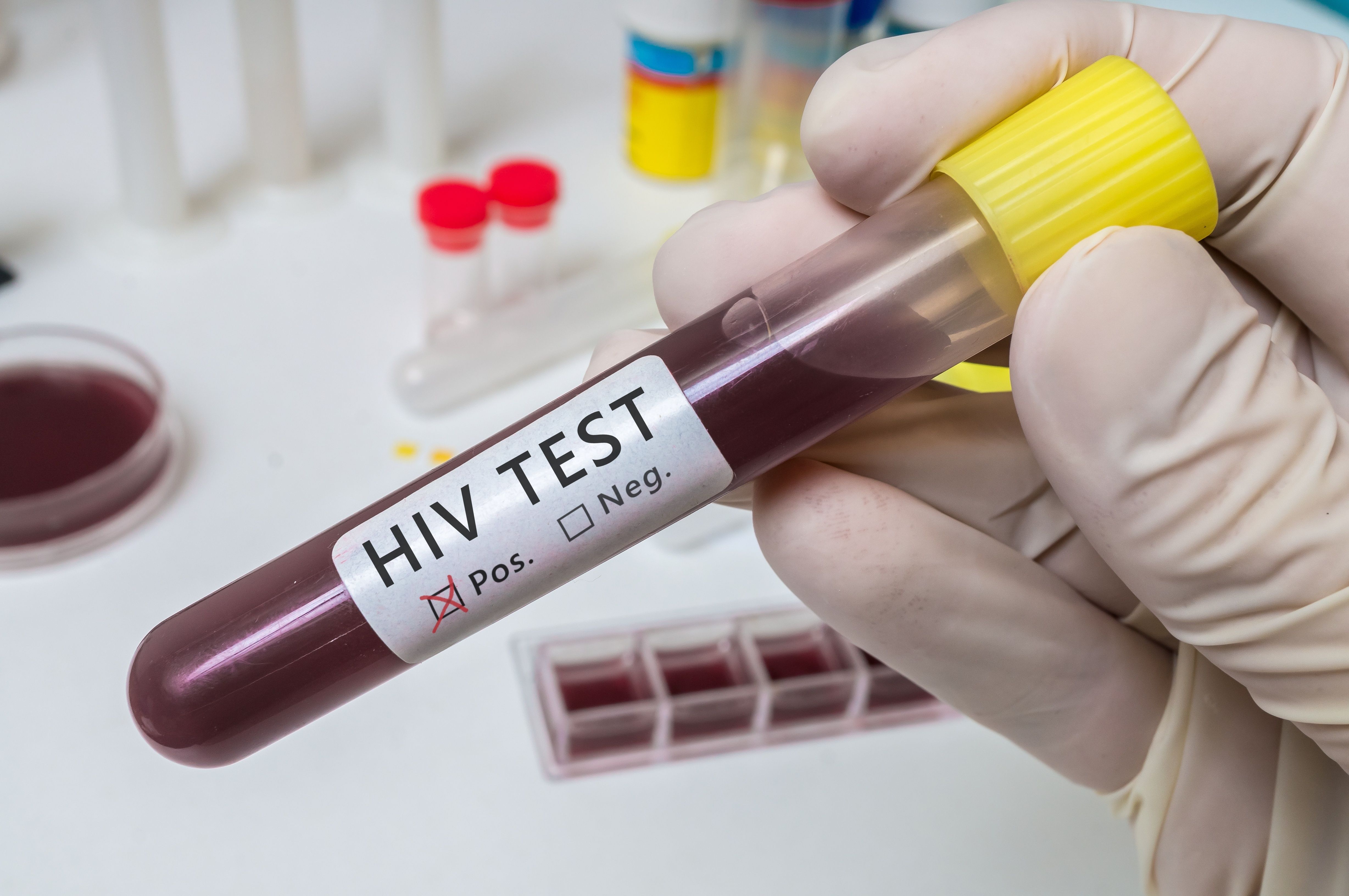 Hand holds test tube for HIV test. | Image Credit: vchalup - stock.adobe.com