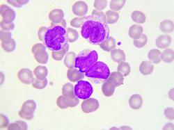 Balancing Toxicity, Tolerability, Efficacy Is Essential for CAR T-Cell Therapies in Indolent B-Cell Lymphoma