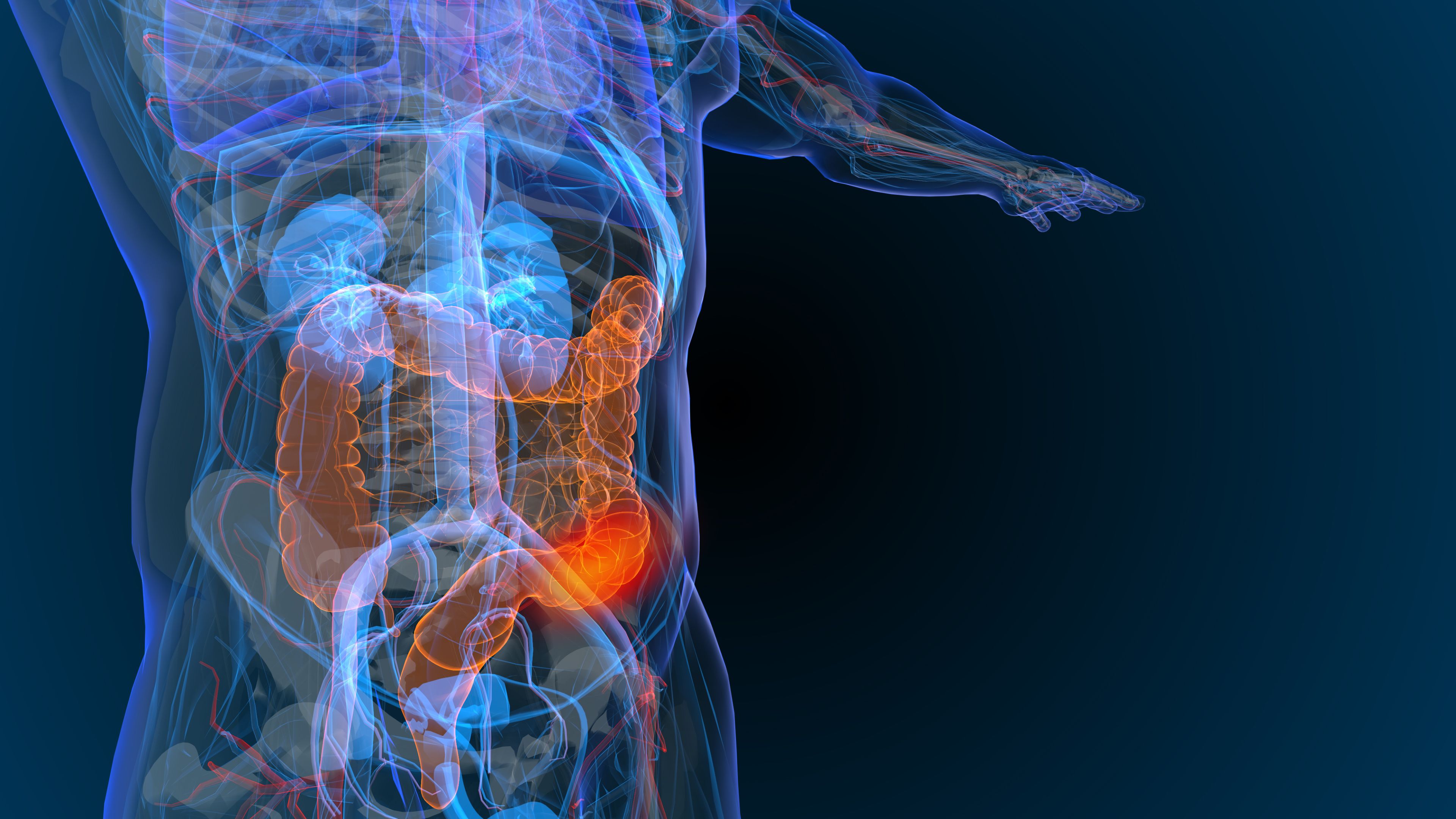 3d rendered illustration of bowel cancer 3D illustration- Image credit: Appledesign | stock.adobe.com