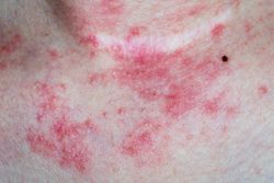 Dupilumab in Atopic Dermatitis and What Pharmacists Should Know