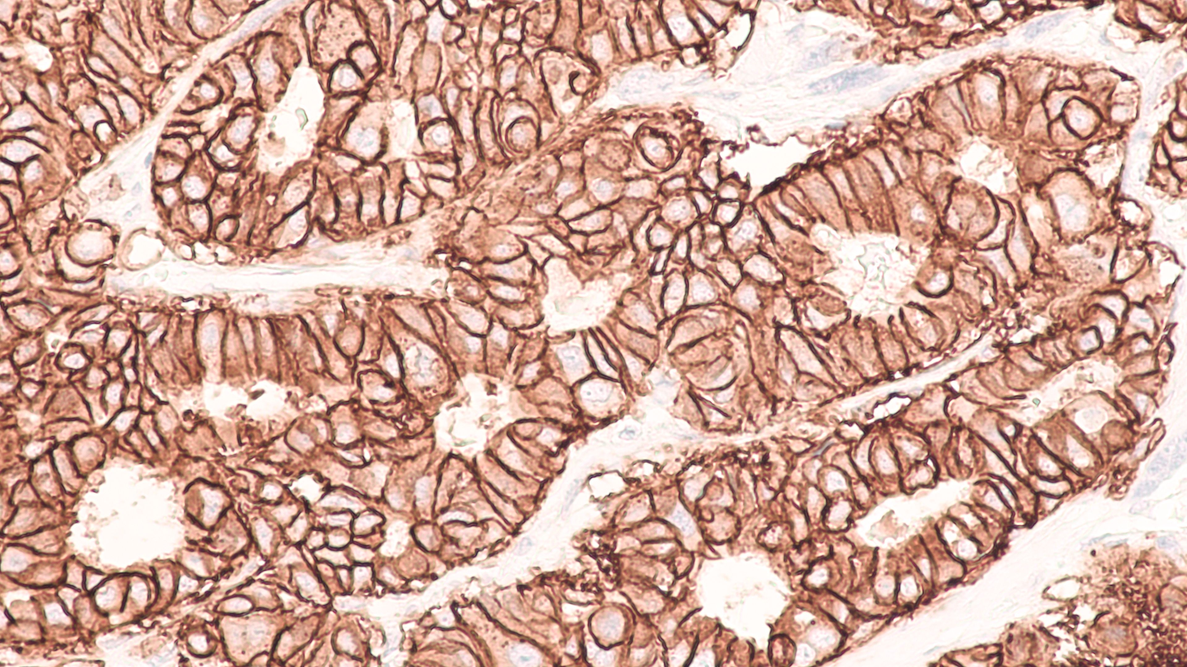 HER2 breast cancer -- Image credit: David A Litman | stock.adobe.com