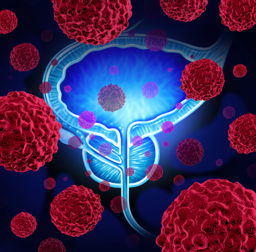 Classification of Prostate Cancer Tumor Molecular Subtype Could Inform ...