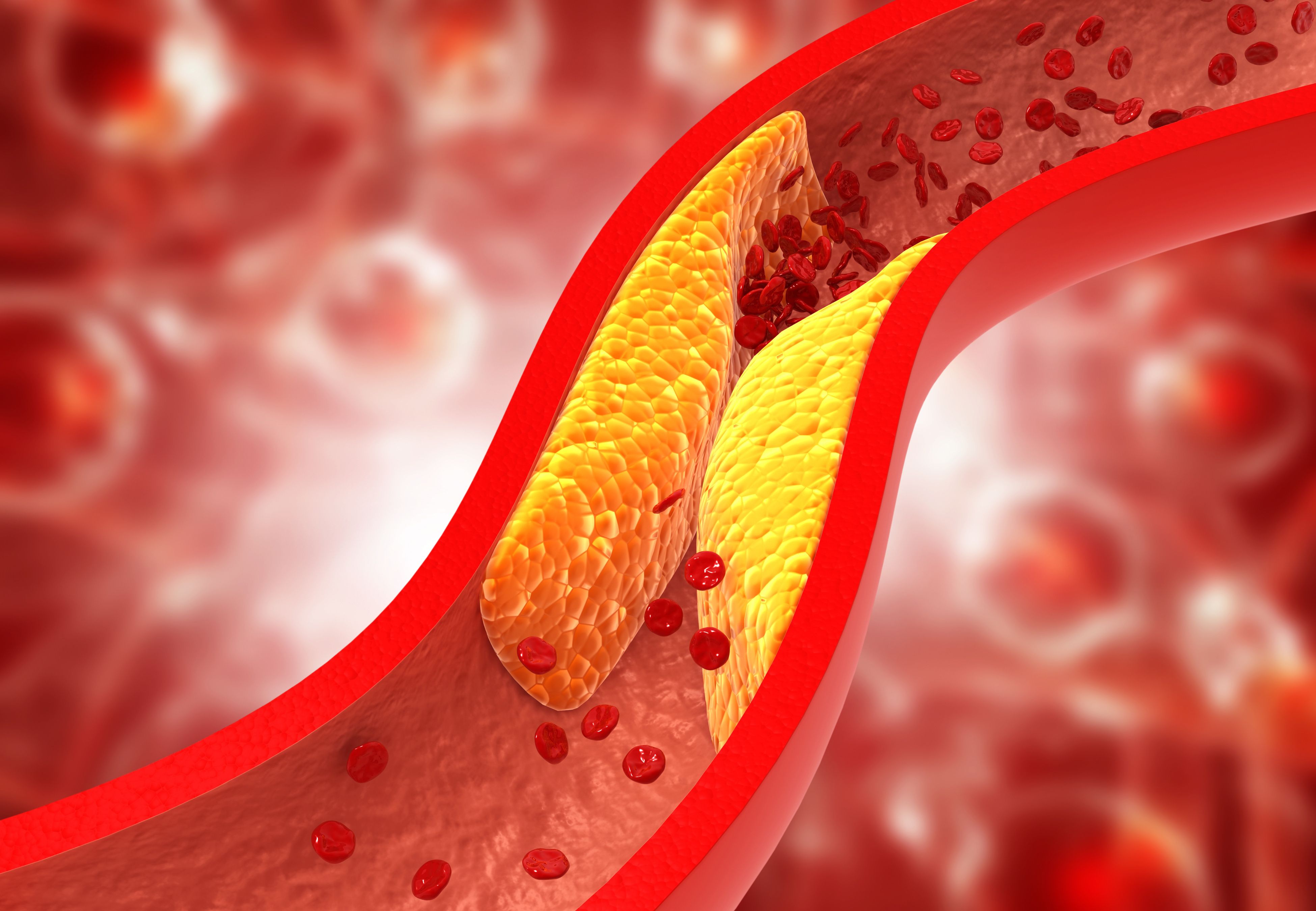 Cholesterol plague in artery -- Image credit: Rasi | stock.adobe.com