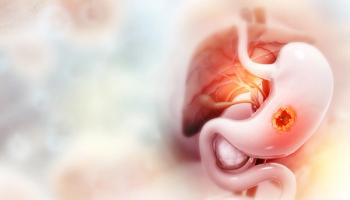 Stomach cancer, gastric cancer, symptoms, stages, treatment, 3d illustration | Image Credit: © Crystal light - stock.adobe.com