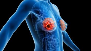 X-ray of tumor in breast -- Image credit: Sebastian Kaulitzki | stock.adobe.com