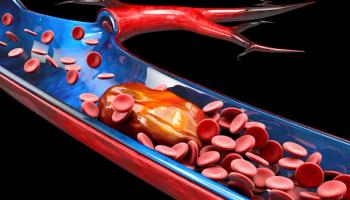 3d Illustration of Deep Vein Thrombosis or Blood Clots. Embolism.