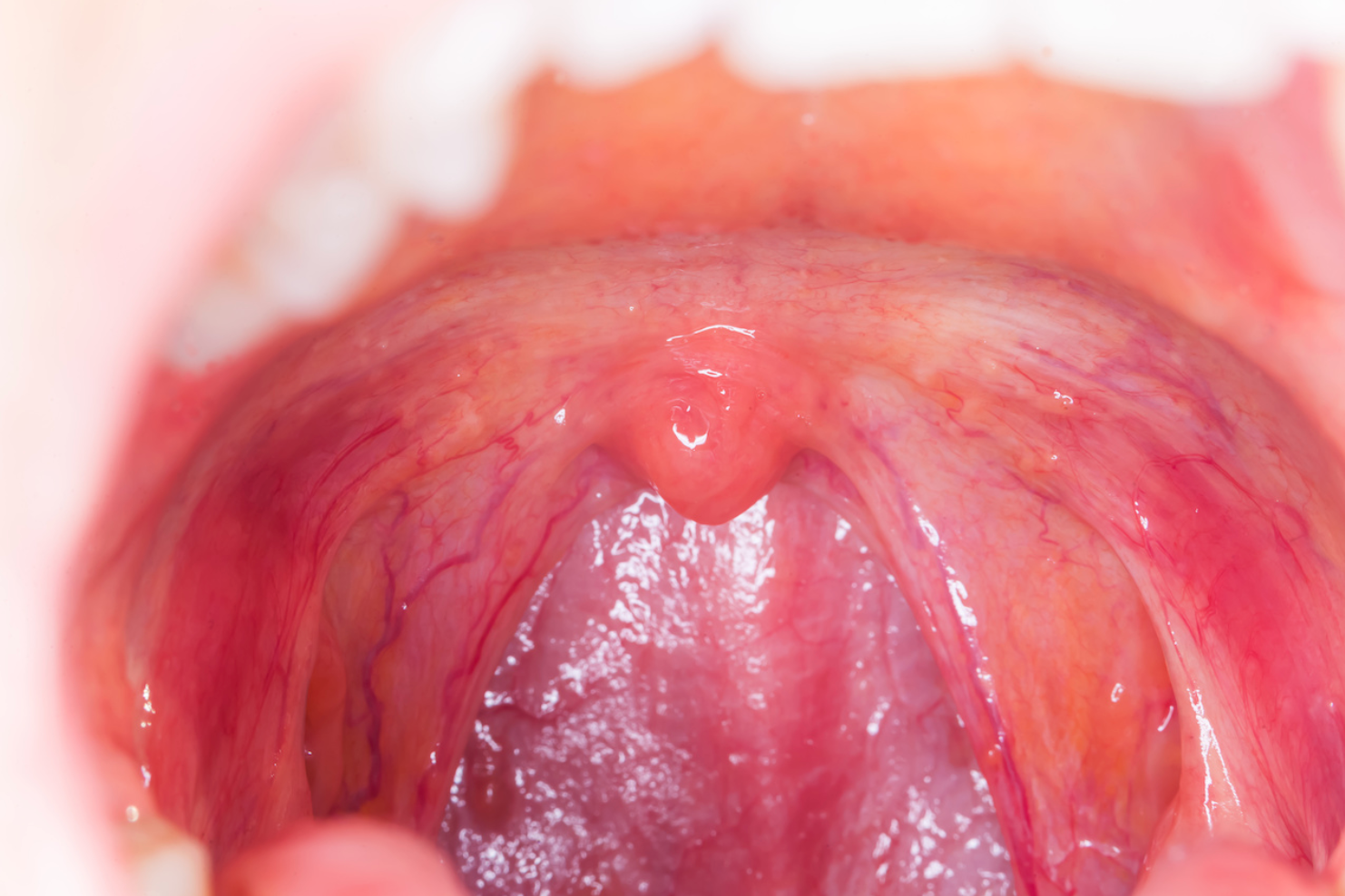 can smoking cigarettes cause tonsillitis Sore Throat: The Top 5 Causes and How to Avoid Them Effects Of Smoking On Tonsils: