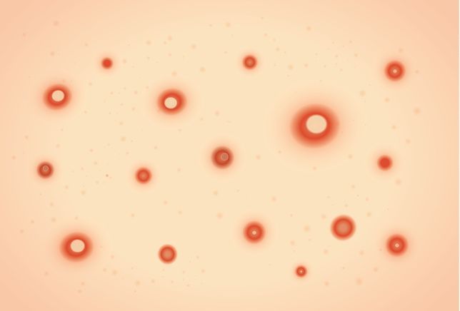 Case Study: Shingles