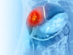 Image Credit: Crystal light | Liver cancer or liver tumor, Hepatocellular carcinoma (HCC), causes, symptoms, treatments, 3d illustration