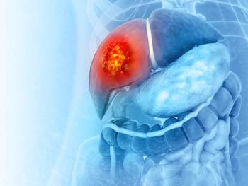 Image Credit: Crystal light | Liver cancer or liver tumor, Hepatocellular carcinoma (HCC), causes, symptoms, treatments, 3d illustration