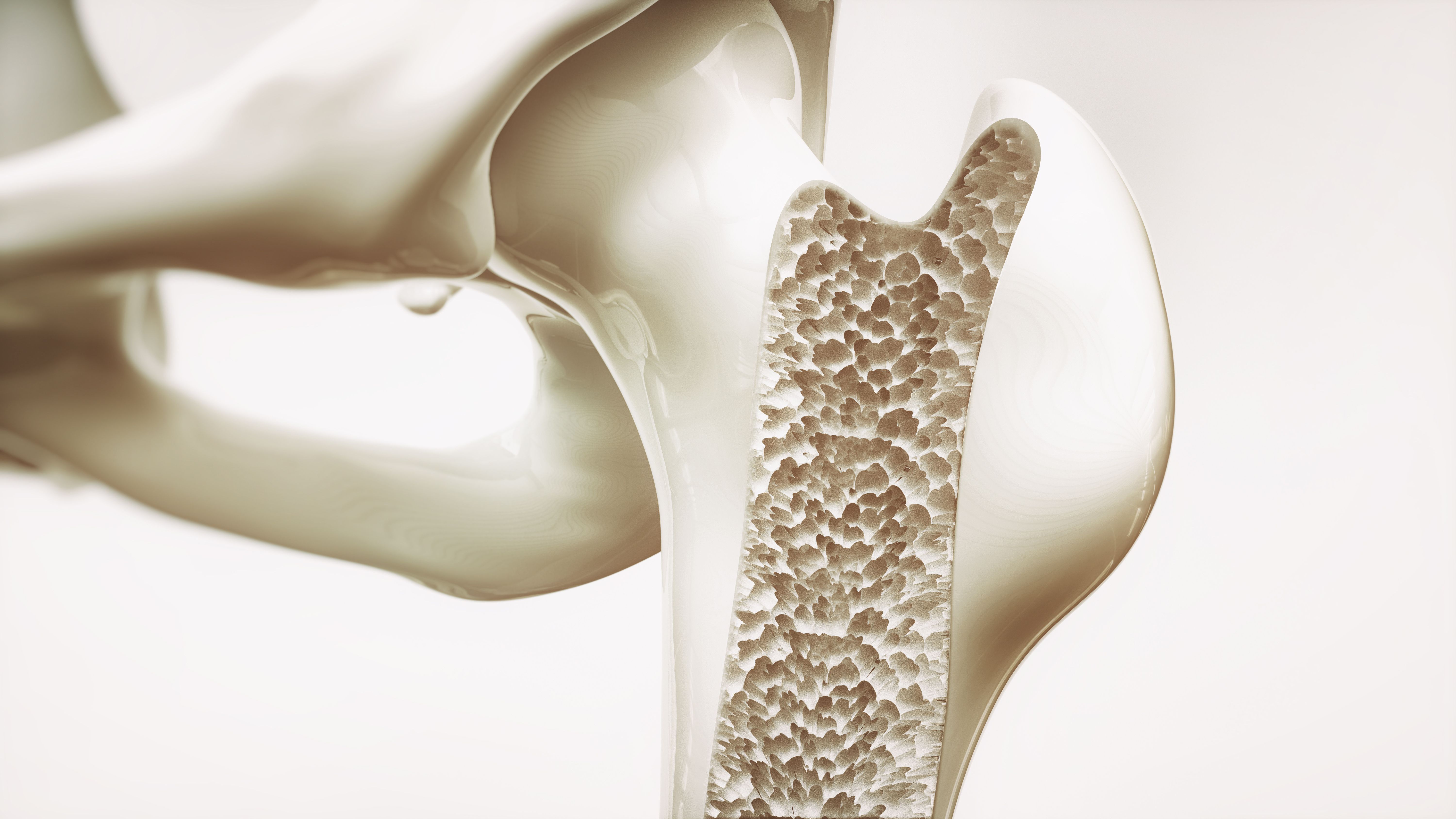 Osteoporosis stage 4 of 4 in upper limb bone.