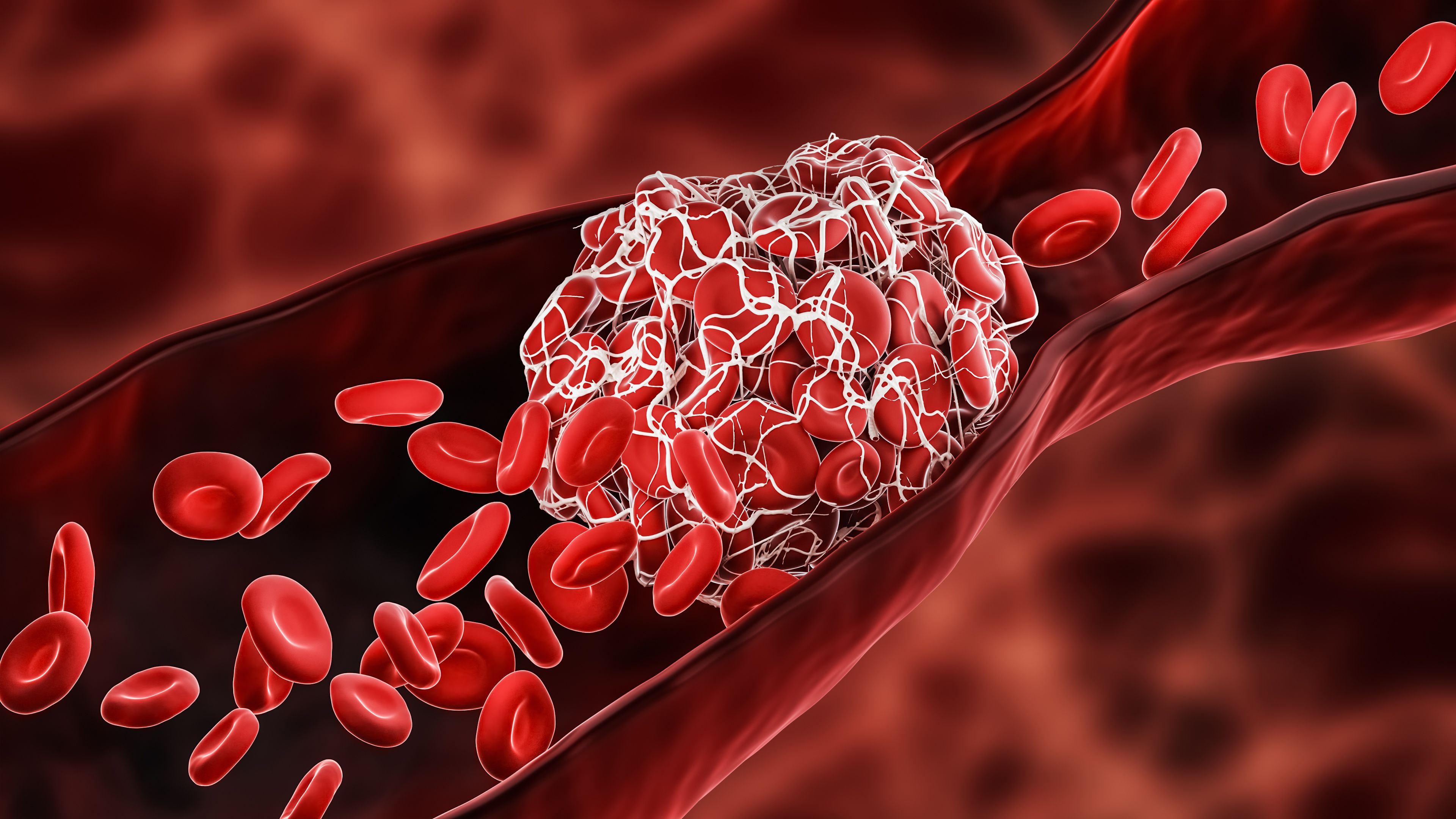 3D rendering of thrombosis in an artery | Image Credit: © Matthieu - stock.adobe.com