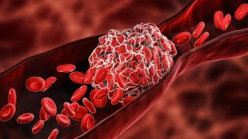 3D rendering of thrombosis in an artery | Image Credit: © Matthieu - stock.adobe.com