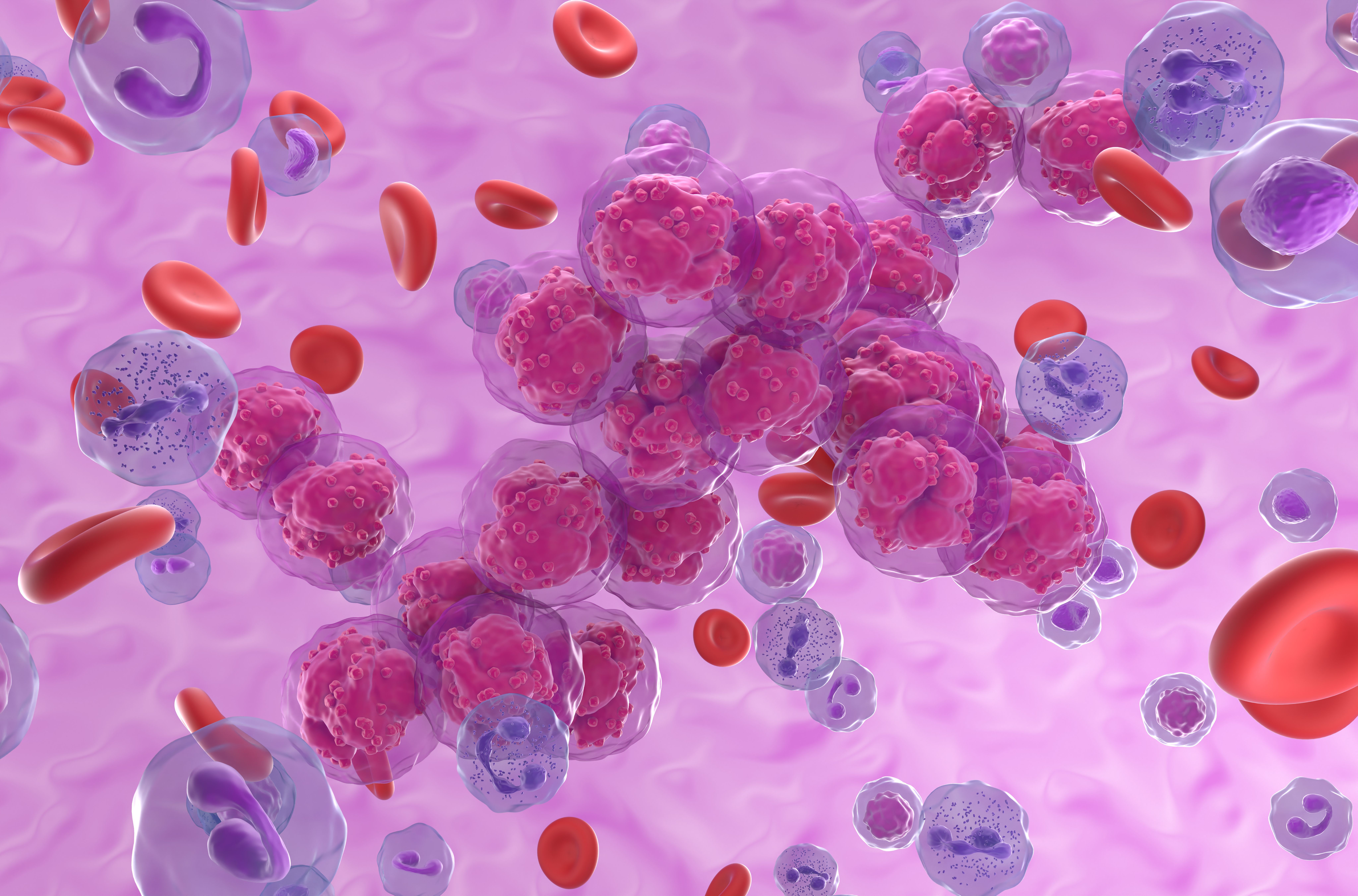 Acute lymphoblastic leukemia (ALL) cancer cell clusters in the blood flow - isometric view 3d illustration | Image Credit: LASZLO | stock.adobe.com