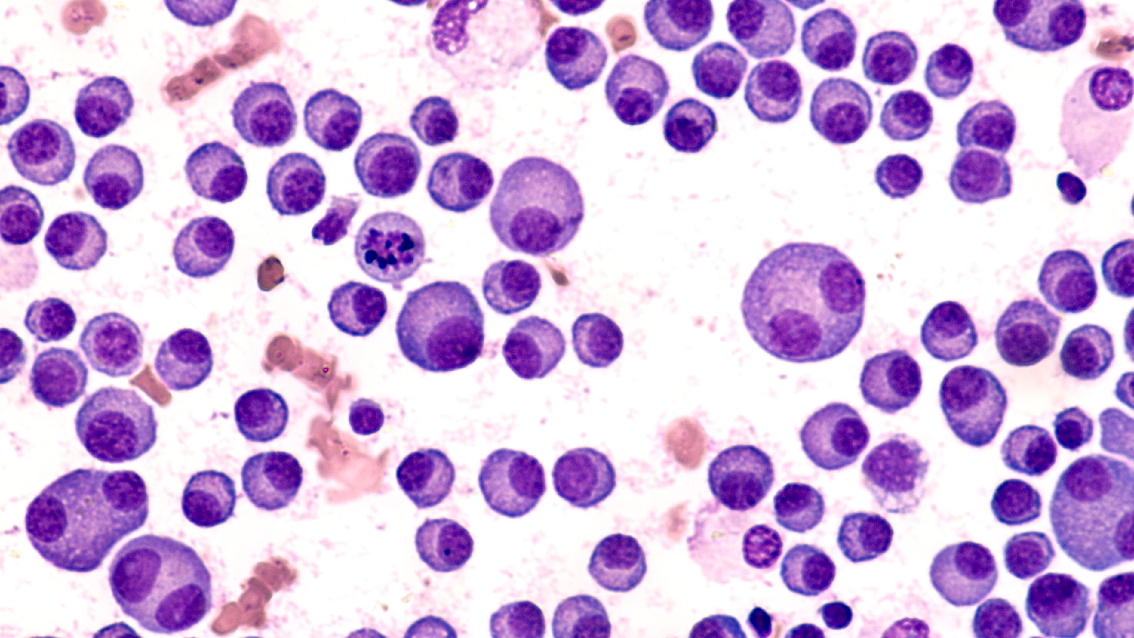 EHA 2025: Early Data Support Tocilizumab Use to Enable Outpatient Talquetamab Dosing in R/R Multiple Myeloma