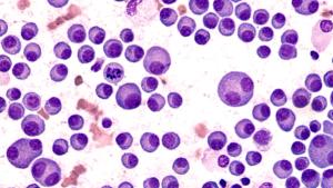 Expert: Linvoseltamab’s Simplified Dosing Expands Access, Enhances Tolerability in Multiple Myeloma