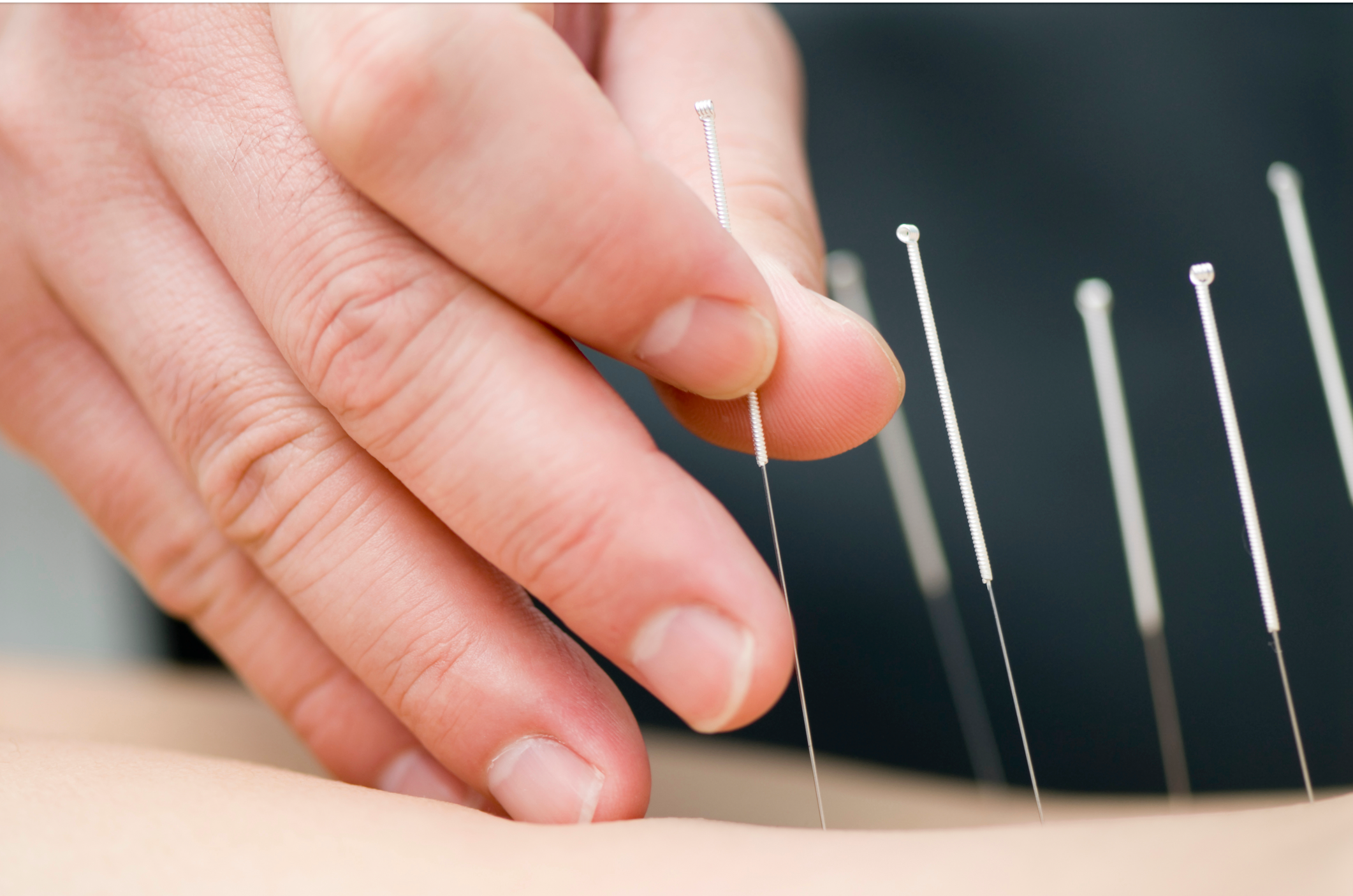 Acupuncture, acupressure may help reduce pain in patients undergoing gynecologic cancer surgery