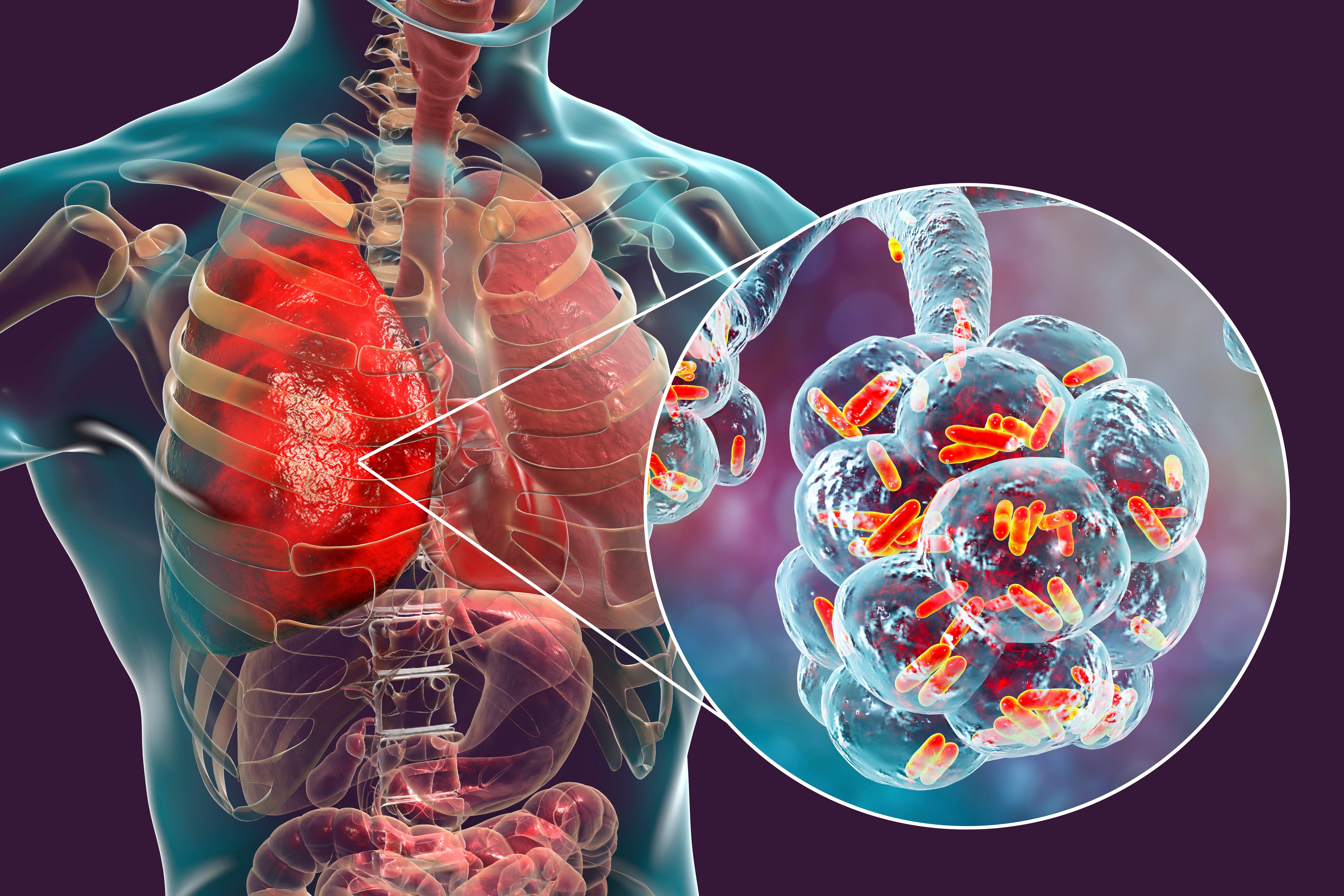Research Reveals Opportunities for Antimicrobial Stewardship When Treating Community-Acquired Pneumonia