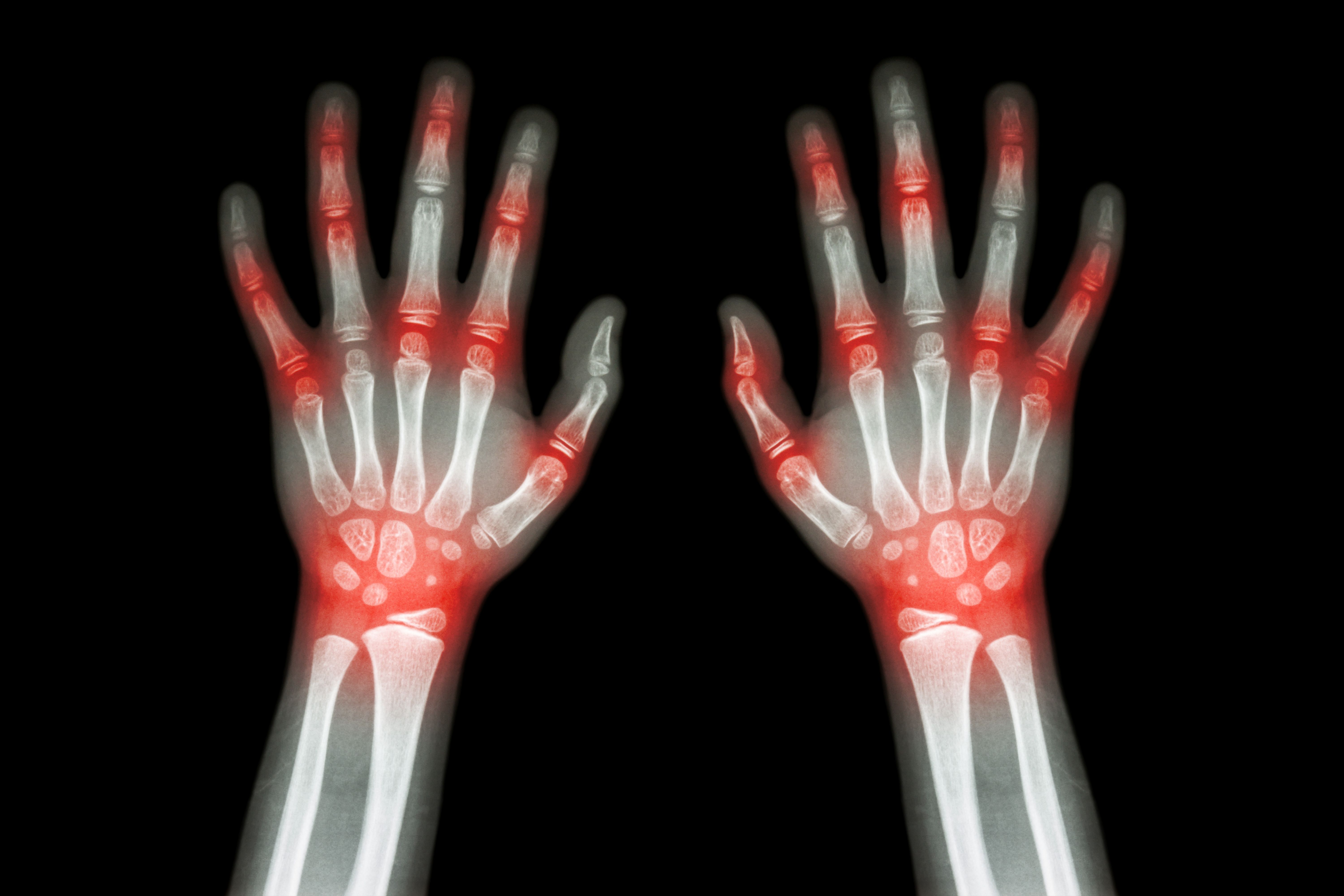 Polyarticular juvenile idiopathic arthritis | Image Credit: stockdevil - stock.adobe.com