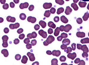 Oncology Overview: Acalabrutinib (Calquence) for Chronic Lymphocytic Leukemia 