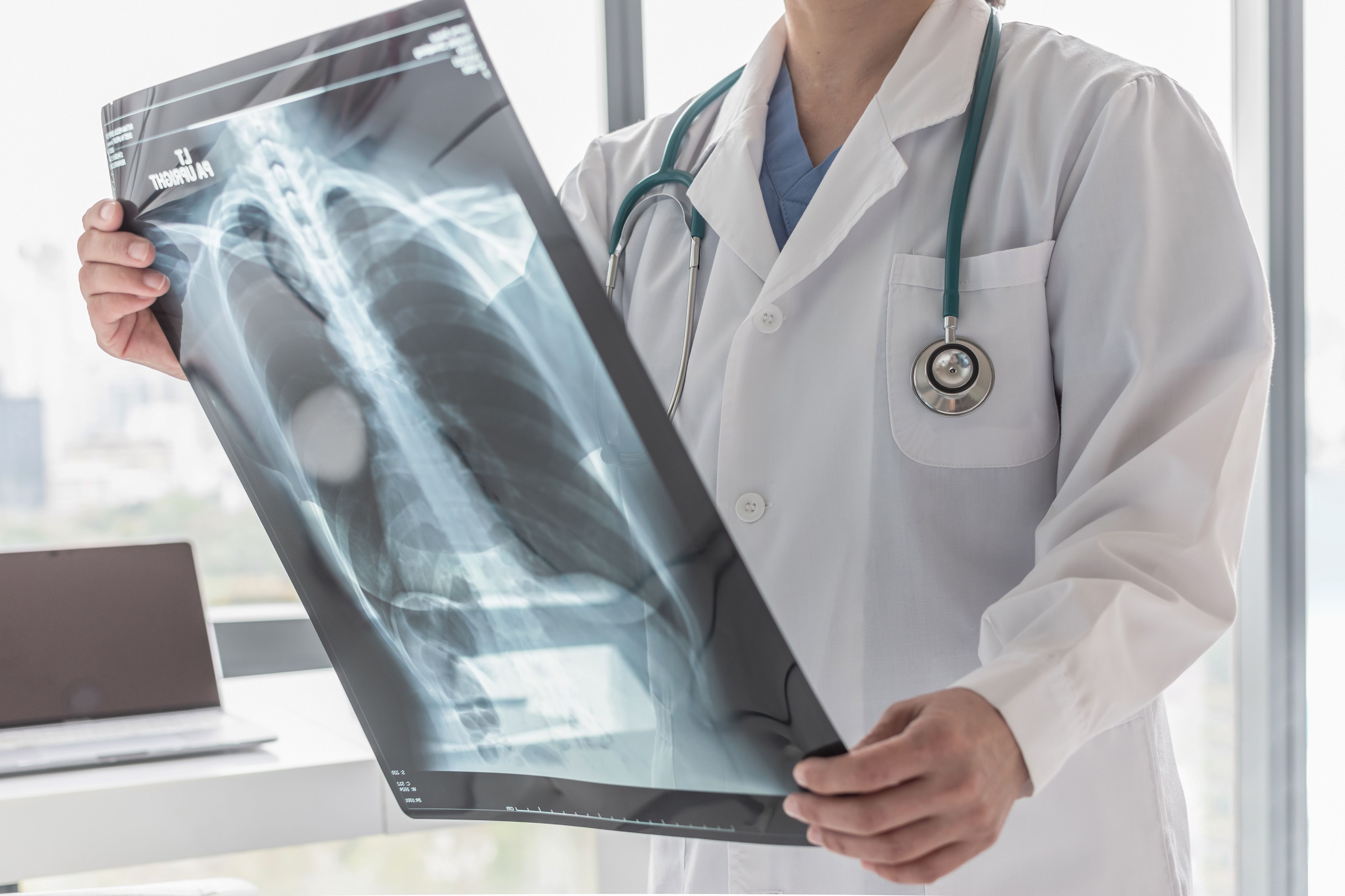 Doctor with radiological chest x-ray film for medical diagnosis on patient’s health on asthma, lung disease and bone cancer illness - Image credit: Chinnapong | stock.adobe.com