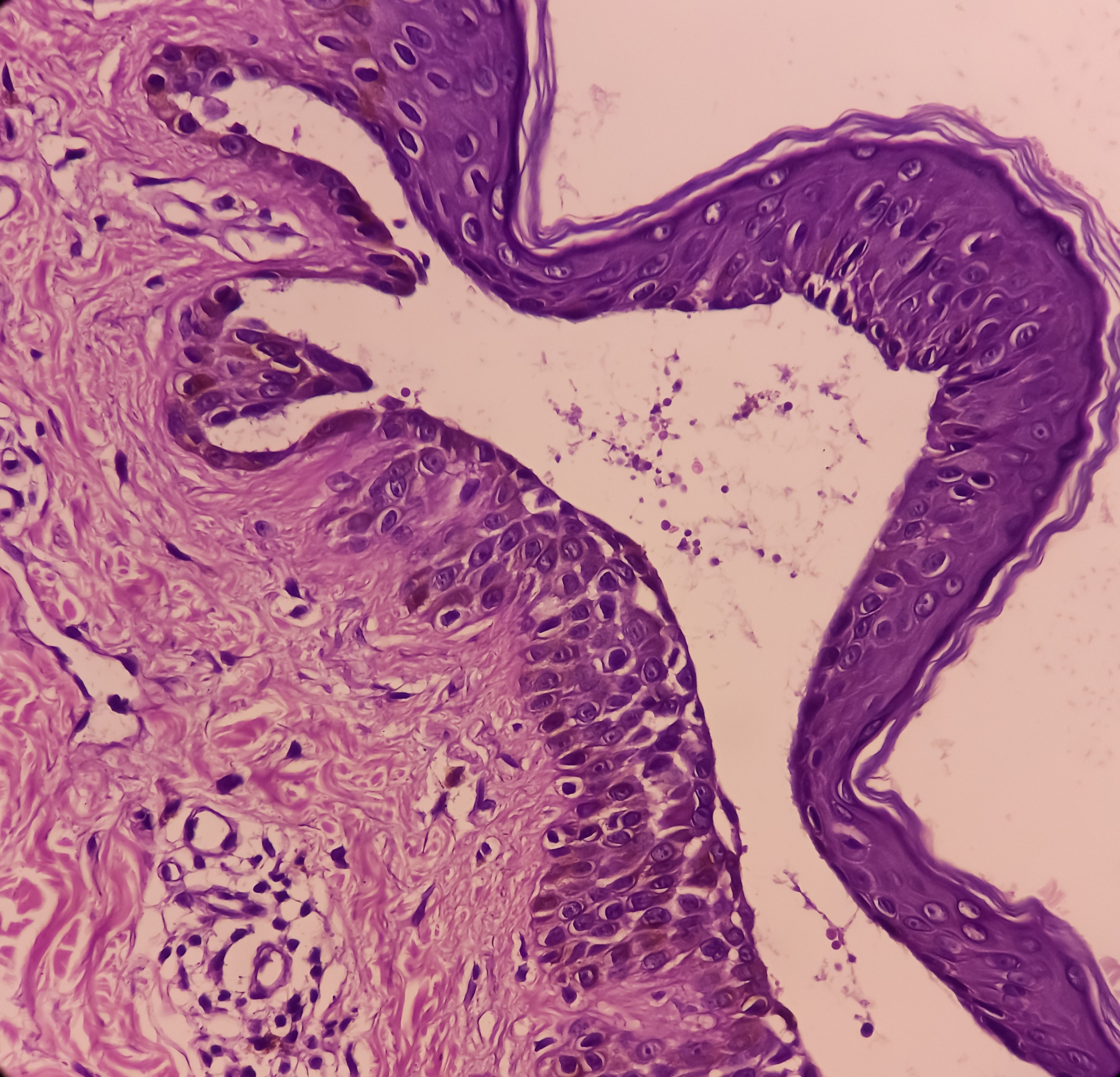 Microscopic image of pemphigus vulgaris.
