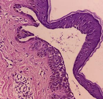 Microscopic image of pemphigus vulgaris.
