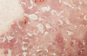Clinical Overview: Deucravacitinib for the Treatment of Moderate to Severe Plaque Psoriasis
