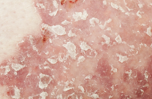 Clinical Overview: Lebrikizumab for Atopic Dermatitis