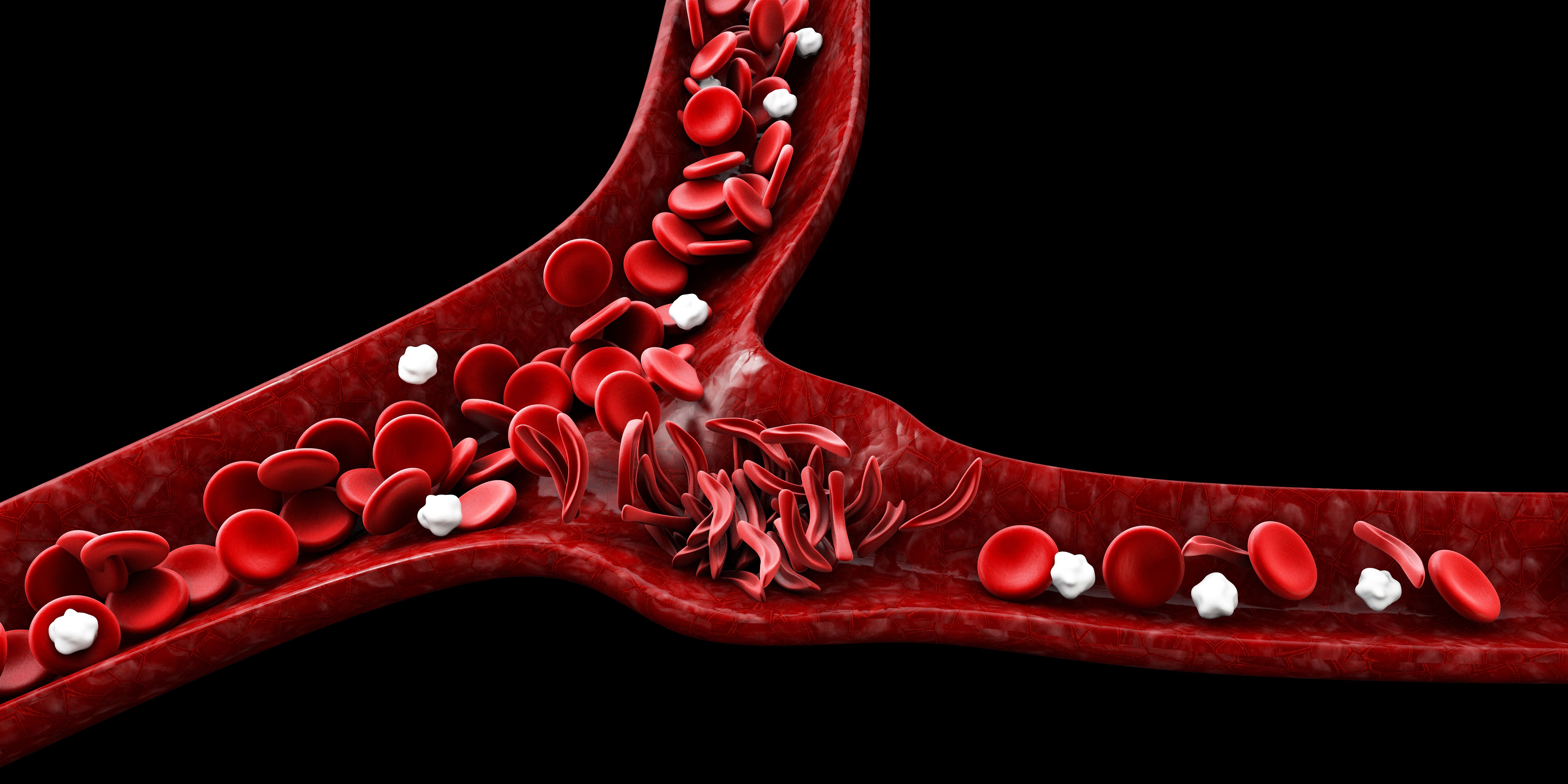 Sickle cell disease (SCD) -- Image credit: tussik | stock.adobe.com