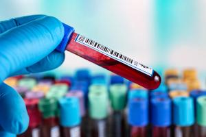 How Subcutaneous Isatuximab Could Compete With Daratumumab in Multiple Myeloma