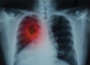 Trastuzumab Deruxtecan Superior to Chemoimmunotherapy in HER2-Mutant Advanced NSCLC