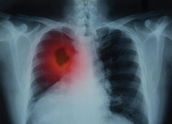 Trastuzumab Deruxtecan Superior to Chemoimmunotherapy in HER2-Mutant Advanced NSCLC