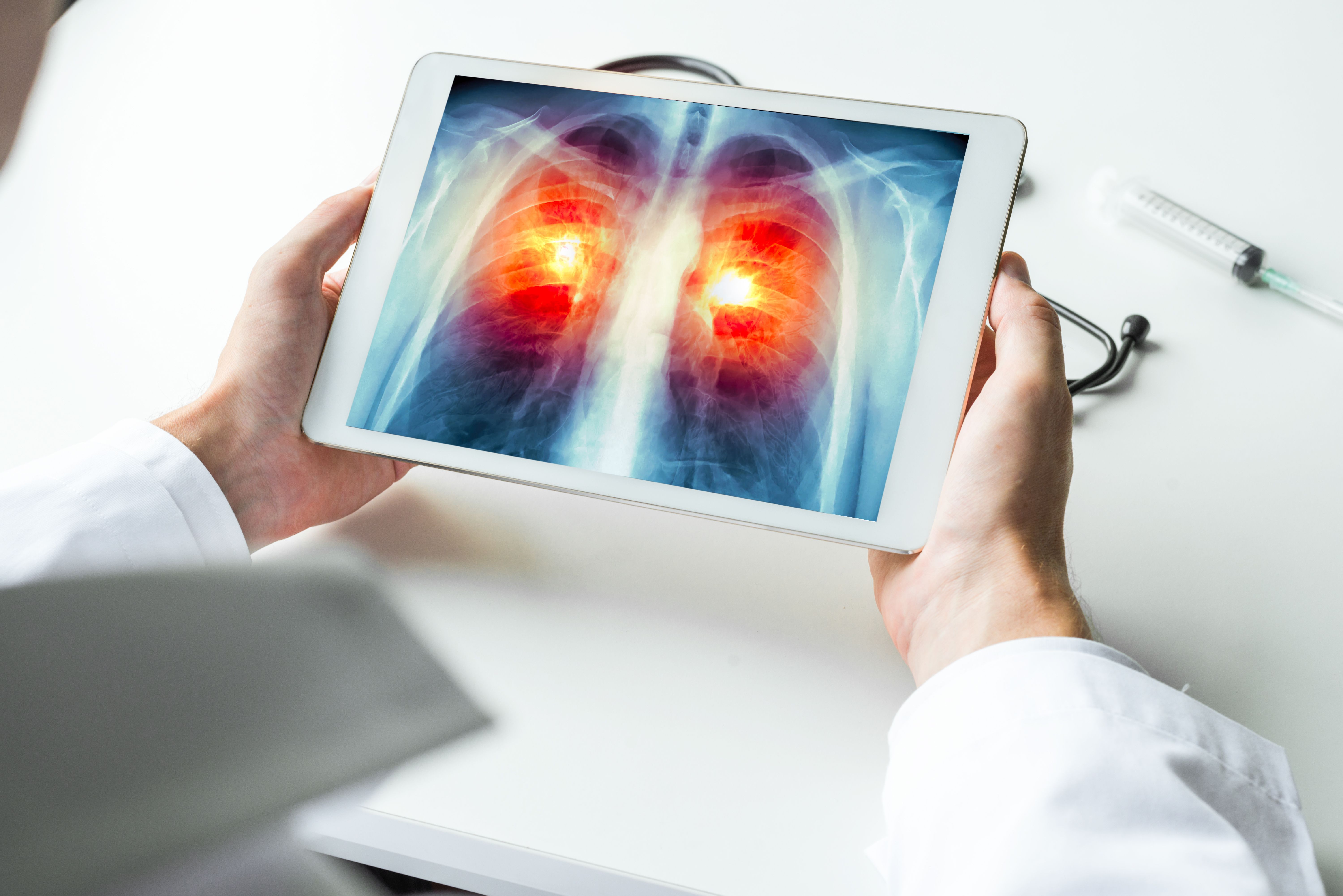 Doctor watching a xray of lung cancer on digital tablet. Radiology concept | Image Credit: steph photographies | stock.adobe.com