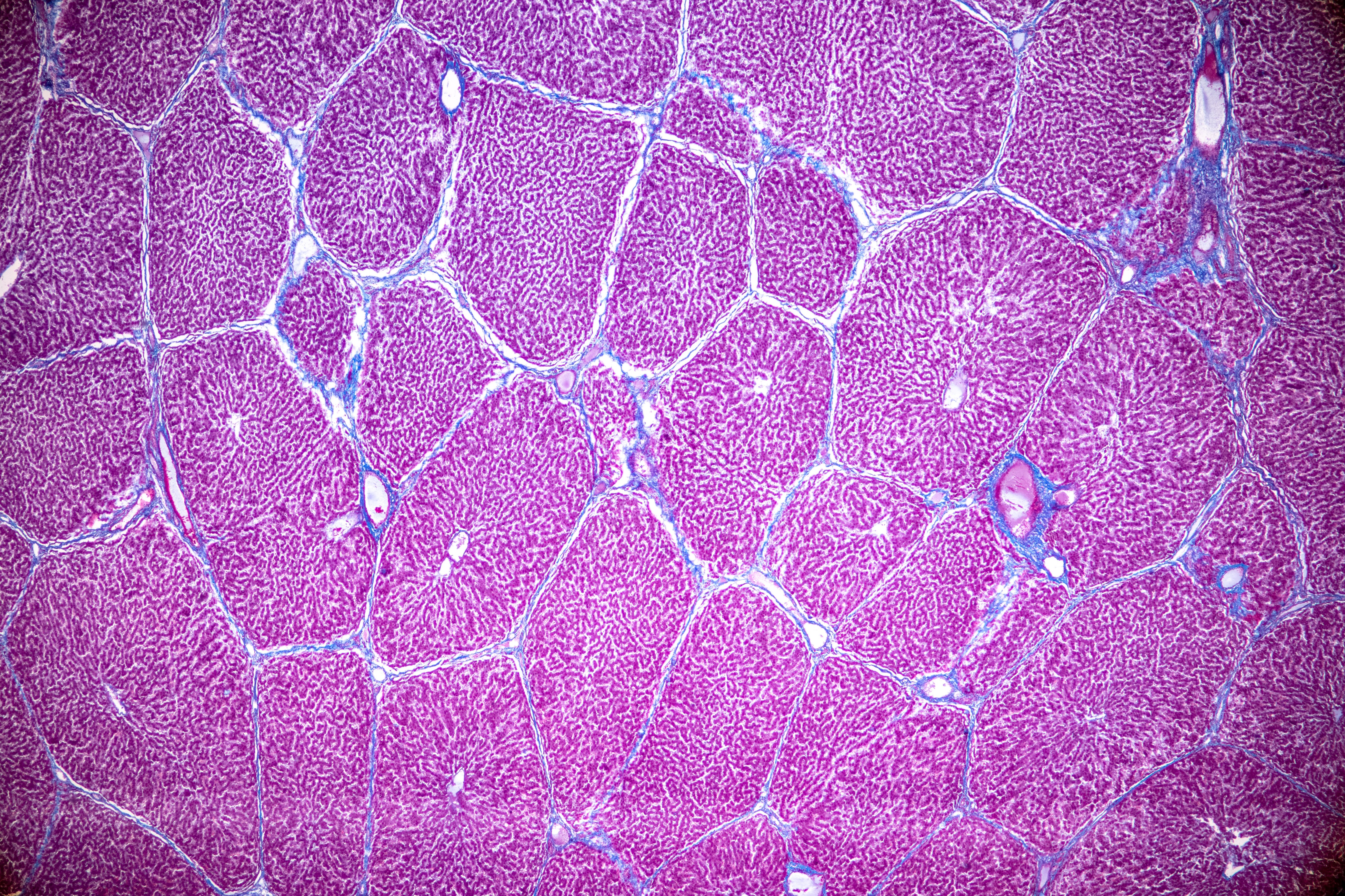 Hepatocellular carcinoma -- Image credit: sinhyu | stock.adobe.com