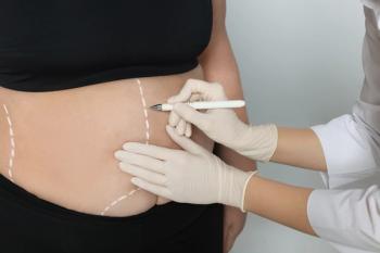 Doctor drawing marks on obese woman's body against light background, closeup. Weight loss surgery- Image credit: New Africa | stock.adobe.com 