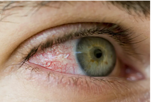 Diabetic Macular Edema Is Treatable, but Prevention Is Best - Vimarsana News