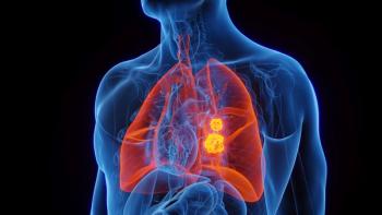 X-ray image of lung cancer -- Image credit: Sebastian Kaulitzki | stock.adobe.com