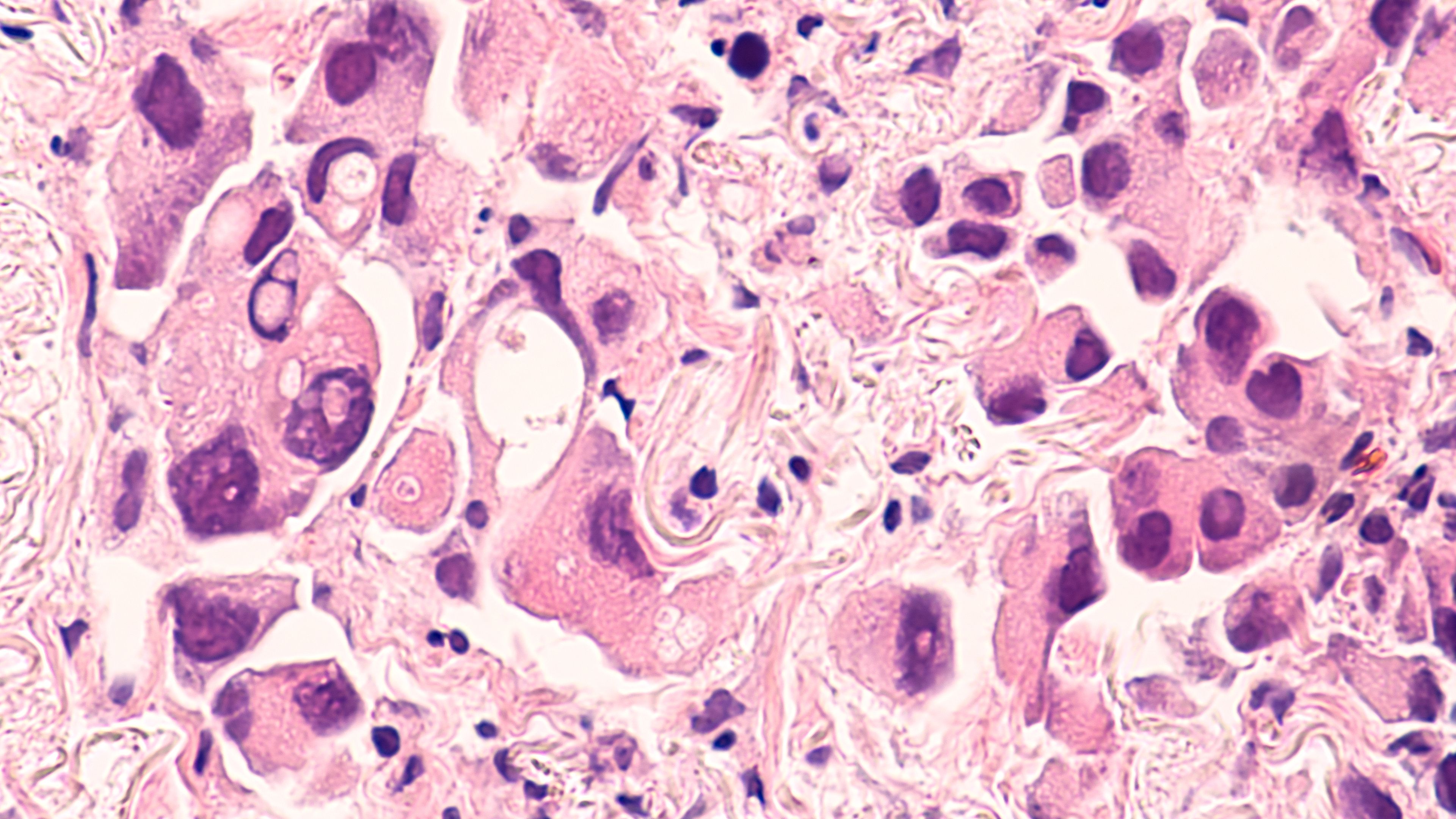 Lung cancer | Image Credit: © David A Litman - stock.adobe.com