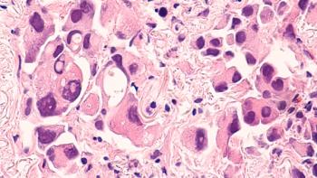 Lung cancer | Image Credit: © David A Litman - stock.adobe.com